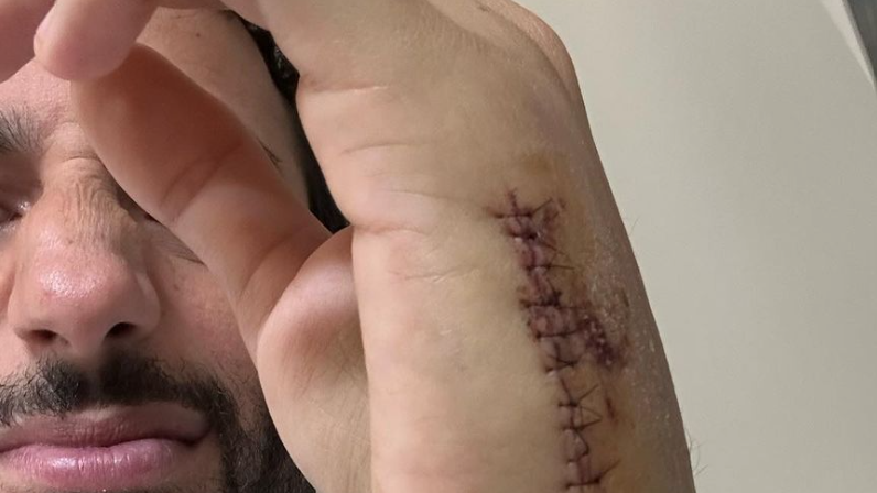 Ricciardo Memperlihatkan Luka Besarnya setelah Operasi